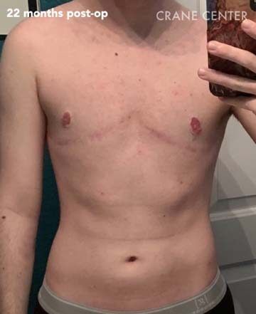 Top surgery scar — 22 months post-op