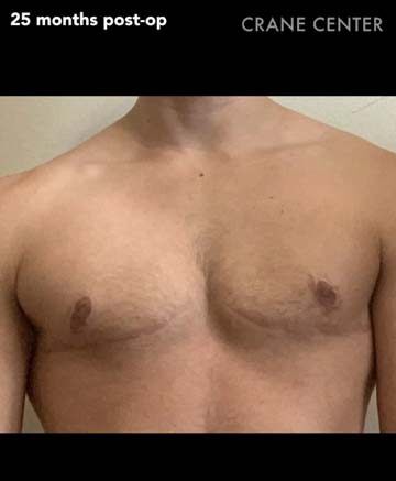 Top surgery scar — side view 25 months