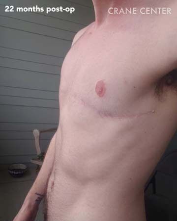Top surgery scar — 22 months healed