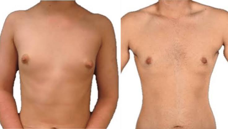Early top surgery healing scar