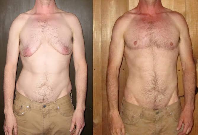 Before and after top surgery comparison