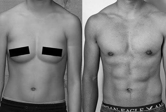 Top surgery chest scar result